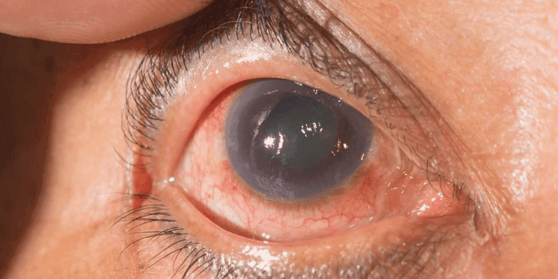 Glaucoma.png